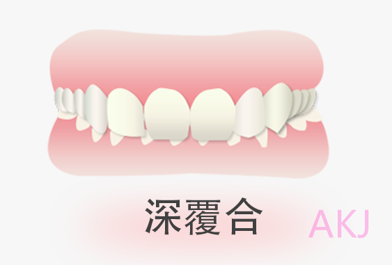 深覆合矯正一般多少錢