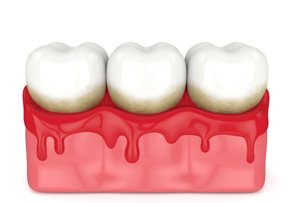 慢性牙周炎是導致成年人牙齒喪失的首要原因!得了慢性牙周炎該如何治療!