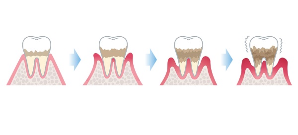 刷牙流血有口臭?如何自己初步判斷有沒有牙周炎?深圳牙周炎治療費用參考！