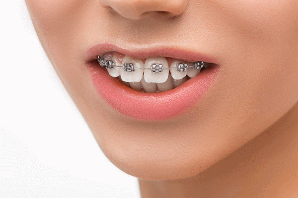 成人矯正牙齒一般要多久完成?為什麼成人矯正需要更長時間?