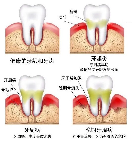 深圳輕度牙周炎系統治療推薦愛康健口腔31年老品牌|牙周病治療支持香港醫療券支付