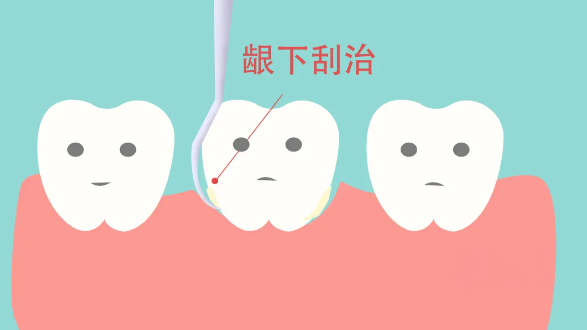 牙齒刮治有必要做嗎
